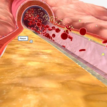 USA Vascular Centers - Example of Peripherial Artery Disease treated by USA Vascular Centers - Vascular Medicine Near Me - Marietta, Georgia USA Vascular Centers - Example of Peripherial Artery Disease treated by USA Vascular Centers - Vascular Medicine Near Me - Marietta, Georgia