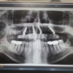 The Dental Atelier - Temporary arch on four implants