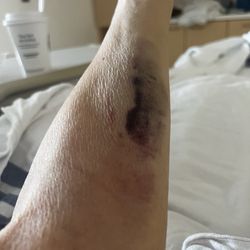 Baptist North Medical Campus - my arm after my IV medication is going into the arm and not my vein