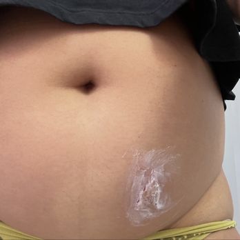Oviedo Med Spa - they gave me a cream but the scar hasnt gone away over a year later - Medical Spas Near Me - Oviedo, Florida Oviedo Med Spa - they gave me a cream but the scar hasnt gone away over a year later - Medical Spas Near Me - Oviedo, Florida