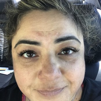 Lucent Cosmetics - Before injections - Medical Spas Near Me - Glendora, California