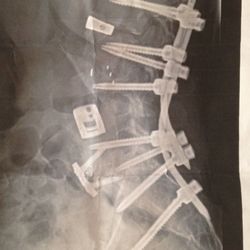Joseph R O'Brien, MD - Original lumbar fusion