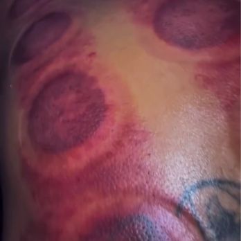 Holt Fit Performance Recovery Center - After the cupping/dynamic cupping. - Massage Therapy Near Me - Aiea, Hawaii Holt Fit Performance Recovery Center - After the cupping/dynamic cupping. - Massage Therapy Near Me - Aiea, Hawaii