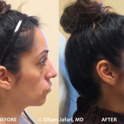 Amoderm Cosmetic & Wellness Medical Center - Liquid Facelift with combination of Botox, Dysport, at forehead & filler injected under the eyes, cheeks, (Voluma,Volbella, Restylane )