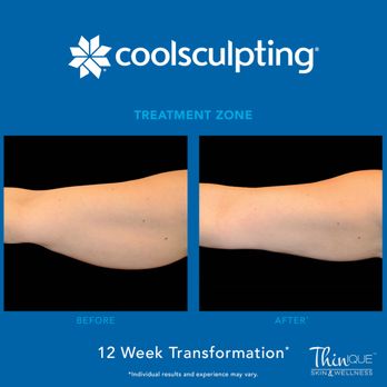 Thinique Skin & Wellness - Ask if CoolSculpting is right for you!!!
Buy 3 Treatments Get 1 FREE!! - Weight Loss Centers Near Me - Fort Worth, Texas Thinique Skin & Wellness - Ask if CoolSculpting is right for you!!!
Buy 3 Treatments Get 1 FREE!! - Weight Loss Centers Near Me - Fort Worth, Texas