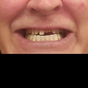 Floss - This is when the whole thing fell out. - Cosmetic Dentists Near Me - San Diego, California