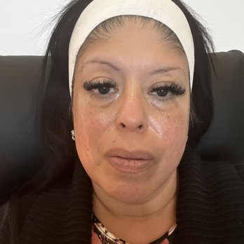 Spa Aesthetica Medical Spa & Wellness Center - Before tear duct injection with hyaluronic acid - Laser Hair Removal Near Me - E Orange, California Spa Aesthetica Medical Spa & Wellness Center - Before tear duct injection with hyaluronic acid - Laser Hair Removal Near Me - E Orange, California