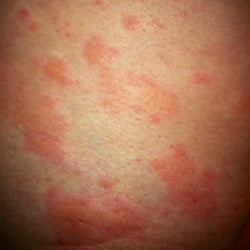 Allergy and Immunology Center - Urticaria (hives) May be a result of allergy or another health abnormality