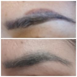 Newco PMU and Aesthetics - Tattoo and PMU Removal and Correction with one application.  Non-Laser with ALL Natural Serum
