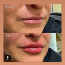 E Med Spa - Lip filler