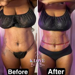 KLoveBeautyBar  - Results 8 sessions of body sculpting radio frequency skin tightening and ultrasonic cavitation