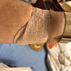 Trusted Medical Centers Mansfield - First attempt at an IV, it blew the vein.