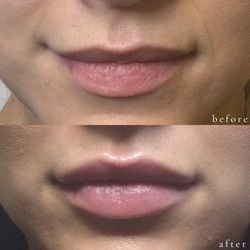 Spa Bella Medispa - 1 syringe of Juvederm Ultra XC.
