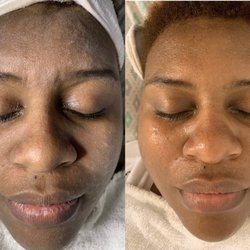 Glam Beauty Bar & Spa - Microdermabrasion