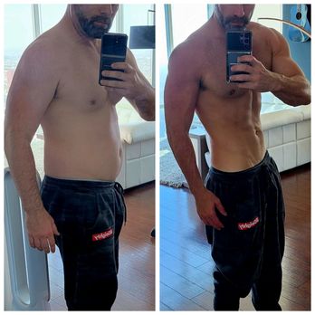 Regenics - Before and after - Medical Spas Near Me - Tarzana, California