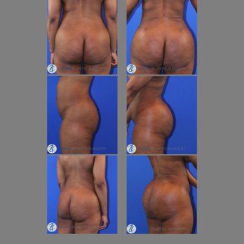 Farris Plastic Surgery - Brazilian Butt Lift - Cosmetic Surgeons Near Me - Dallas, Texas