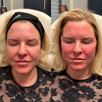 Phi Aesthetics - Before and After PDO threads - Aestheticians Near Me - Franklin, Tennessee Phi Aesthetics - Before and After PDO threads - Aestheticians Near Me - Franklin, Tennessee