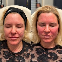 Phi Aesthetics - Before and After PDO threads