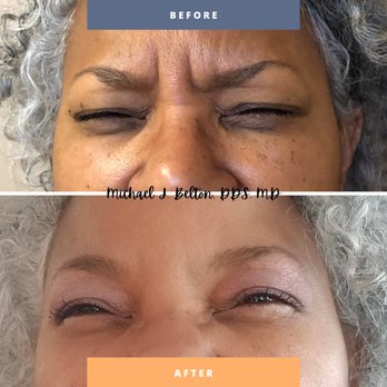 COFIS Oral Surgery - Before and after Glabellar lines (between the eyebrows). - Oral Surgeons Near Me - Corona, California