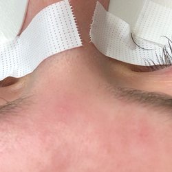 Savvy Skin Aesthetics - Before and after