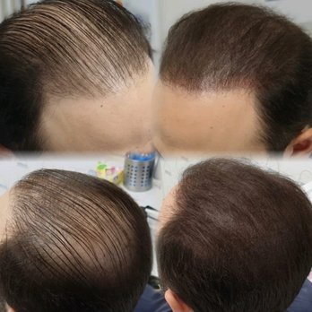 Reveal Hair Restoration Clinic Hair Loss Centers 1070 Sw Bayshore Blvd Port St Lucie Fl Phone Number Yelp