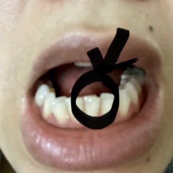 Hercules Dental Care - My chipped tooth - Periodontists Near Me - Hercules, California
