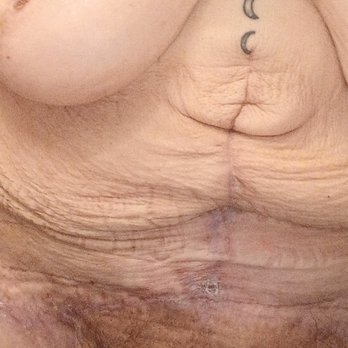 Zoe Plastic Surgery - Reconstructive tummy tuck repair - Plastic Surgeons Near Me - Miami, Florida Zoe Plastic Surgery - Reconstructive tummy tuck repair - Plastic Surgeons Near Me - Miami, Florida