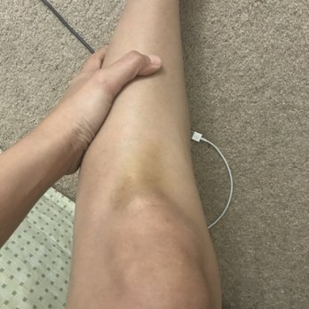 Tequila Jack's - Bad fall from the restaurant resulting to bruised leg and knee - Bars Near Me - Long Beach, California Tequila Jack's - Bad fall from the restaurant resulting to bruised leg and knee - Bars Near Me - Long Beach, California