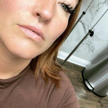 Skin Theory - Before injections - Laser Hair Removal Near Me - Corona, California