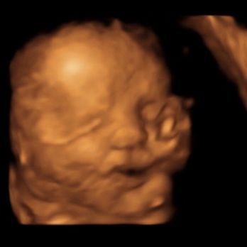 Unique Ultrasound Surprise - Looks like she is melting... - Ultrasound Imaging Centers Near Me - Surprise, Arizona Unique Ultrasound Surprise - Looks like she is melting... - Ultrasound Imaging Centers Near Me - Surprise, Arizona