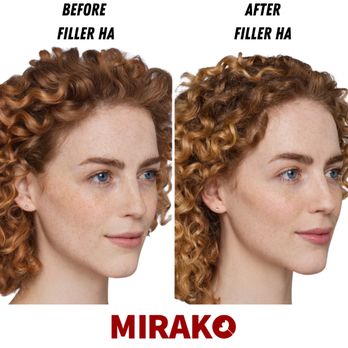 Mirako Spa - Filler - Patient Result - Medical Spas Near Me - Brea, California Mirako Spa - Filler - Patient Result - Medical Spas Near Me - Brea, California