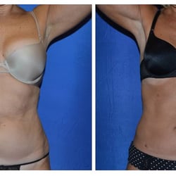 Chicago Cosmetic Institute - Tummy liposuction