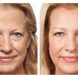 Beverly Hills Rejuvenation Center - Westlake Village - PRP before and after