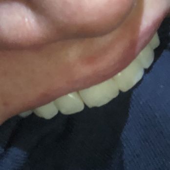 LoPour & Associates DDS - Chipped tooth - General Dentistry Near Me - Albuquerque, New Mexico LoPour & Associates DDS - Chipped tooth - General Dentistry Near Me - Albuquerque, New Mexico