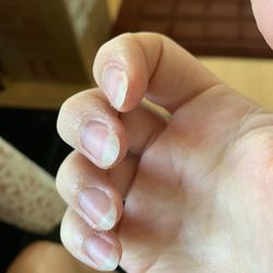 Nails and skin from acetone left on for too long