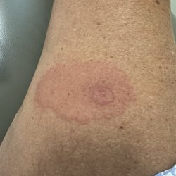 Lowcountry Urgent Care - Initial bee stick (circled) and venom spear, which doubled while waiting in the exam room for a doctor.
