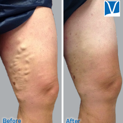 Inovia Vein Specialty Centers - Before & after varicose vein treatment