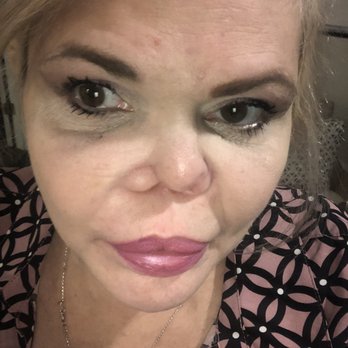 R Laurence Berkowitz, MD - 4 weeks post 2nd Surgery - Cosmetic Surgeons Near Me - San Jose, California