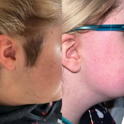 Face waxes - Before and afters of our unibrow, cheek, sideburn, lip, chin and full face waxes