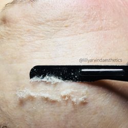 Lilly Arvind Skin Clinic - Dermaplaning is a great way to exfoliate dead skin
