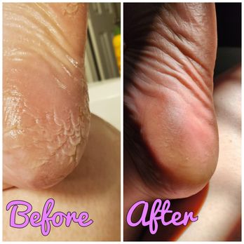 Vegas Nail Bar - 5 sessions with Tina and my skin is so much better. January 2024. - Nail Salons Near Me - Las Vegas, Nevada Vegas Nail Bar - 5 sessions with Tina and my skin is so much better. January 2024. - Nail Salons Near Me - Las Vegas, Nevada