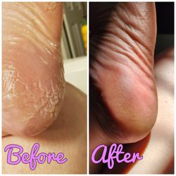 Vegas Nail Bar - 5 sessions with Tina and my skin is so much better. January 2024.