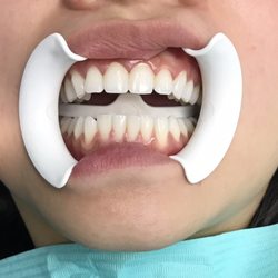 Bolsa Dental - Teeth whitening
