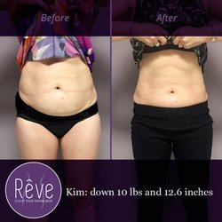 Rêve Body Sculpting - Lexington - Fat loss before and after at Rêve Body Sculpting in Lexington KY