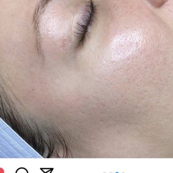 It's a Secret Med Spa - Hydro facial with JAYDEN. No redness. No cuts. AFTER photo! Beautiful work. - Medical Spas Near Me - Scottsdale, Arizona