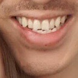 BEFORE: not straight, cross-bite, embarrassing to smile.