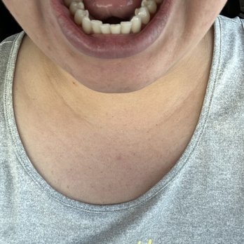 Valley Alder Family Dentistry - 4 metal fillers gone!! - General Dentistry Near Me - Bloomington, California Valley Alder Family Dentistry - 4 metal fillers gone!! - General Dentistry Near Me - Bloomington, California