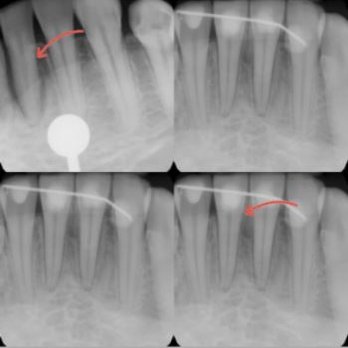 Sahar Verdi, DDS - A before and after Osseous Surgery - Periodontists Near Me - Los Angeles, California Sahar Verdi, DDS - A before and after Osseous Surgery - Periodontists Near Me - Los Angeles, California