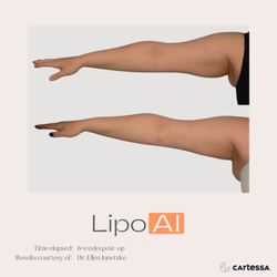 Revivamed Plastic Surgery - Temecula - LipoAI can be used to treat arm skin laxity and fat deposits.