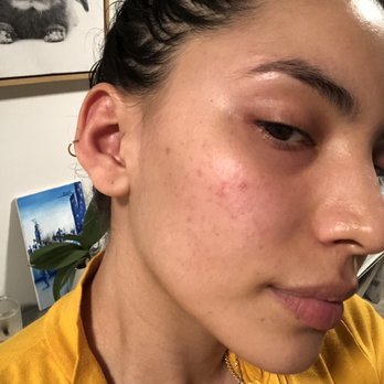 Skin Solutions - After 3 treatments (the redness is just my rosacea) - Skin Care Near Me - Flushing, New York Skin Solutions - After 3 treatments (the redness is just my rosacea) - Skin Care Near Me - Flushing, New York